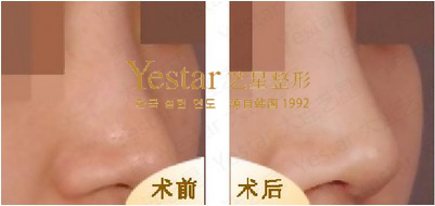 点击咨询艺星效果 了解您隆鼻以后可以达到的样子