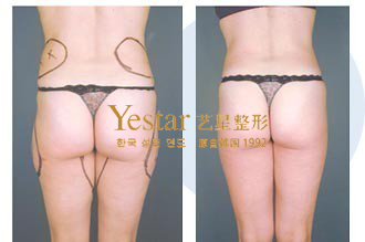腰臀部吸脂对比图