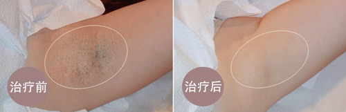 腋毛